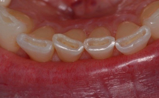 Bruxism - grinding of teeth