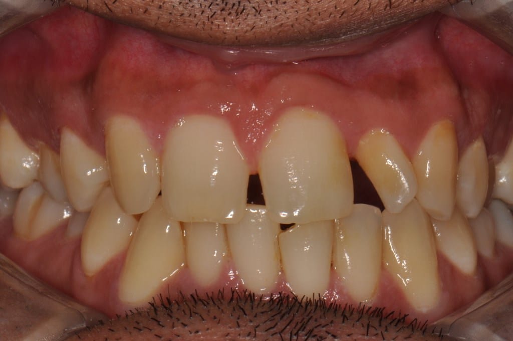 Before Straight Teeth Braces