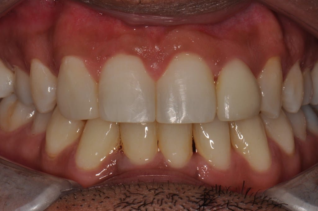 After Straight Teeth Braces