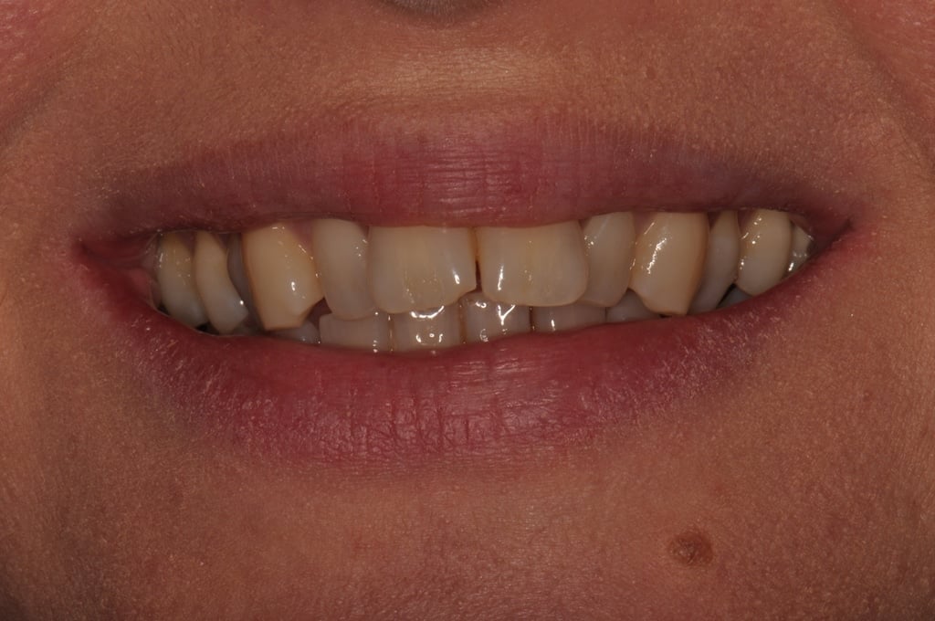 Before Straight Teeth Braces