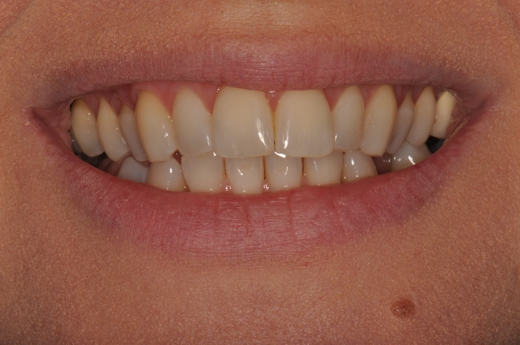 After Straight Teeth Braces
