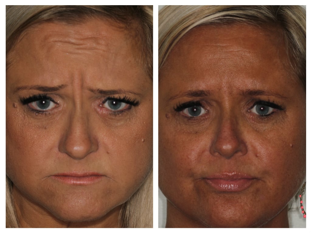 Before and After Treatment