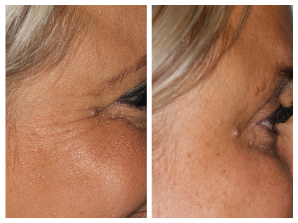 Before and After Treatment