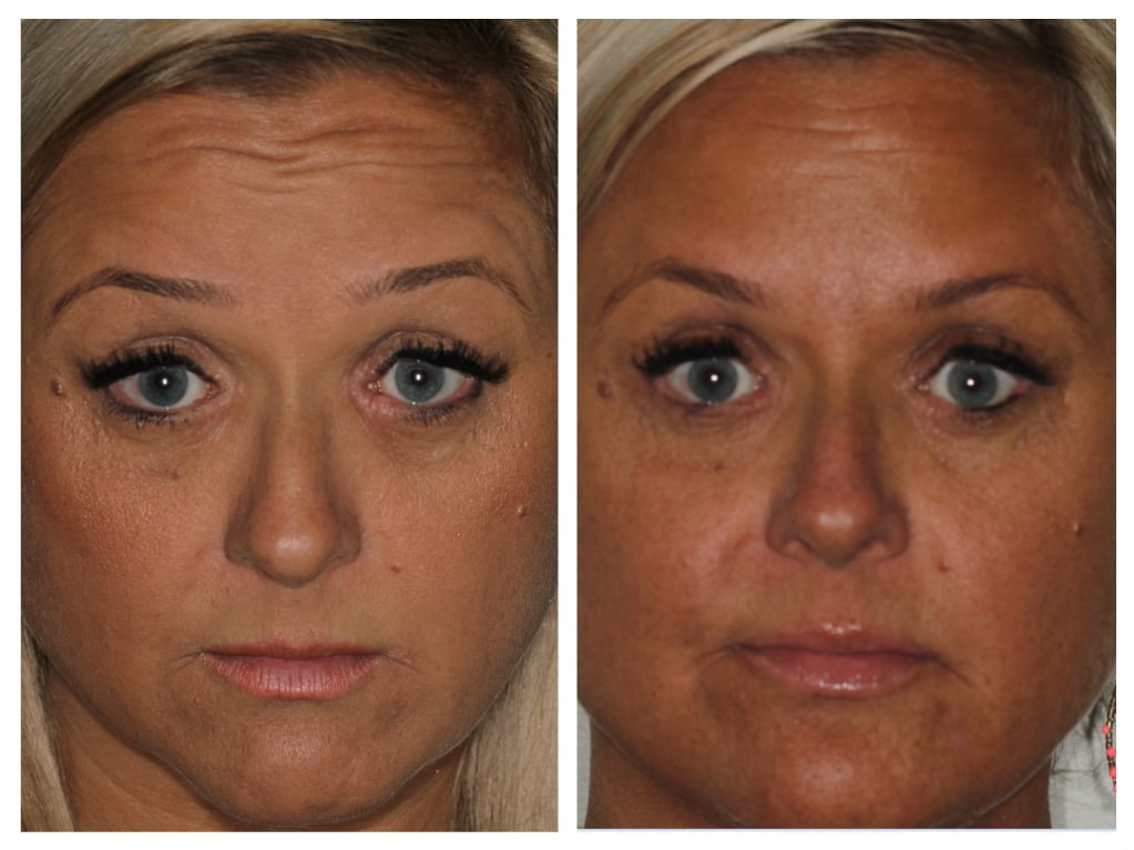 Before and After Treatment