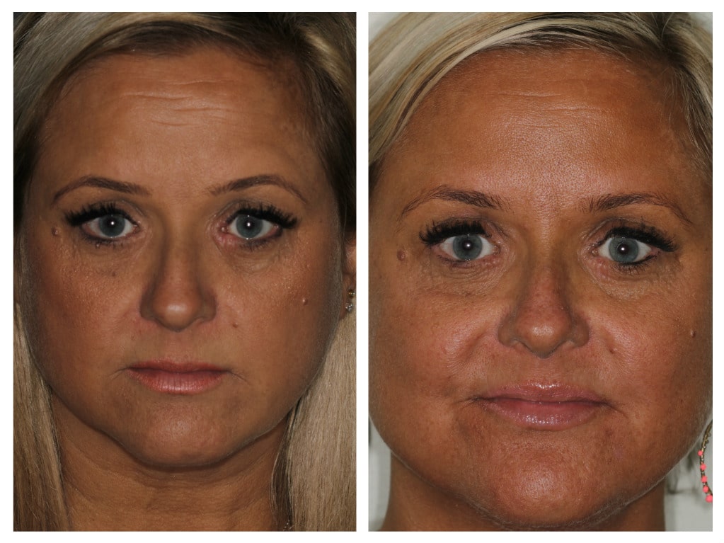 Before and After Treatment